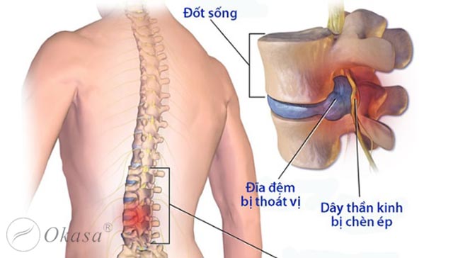 Phương pháp điều trị thoát vị đĩa đệm