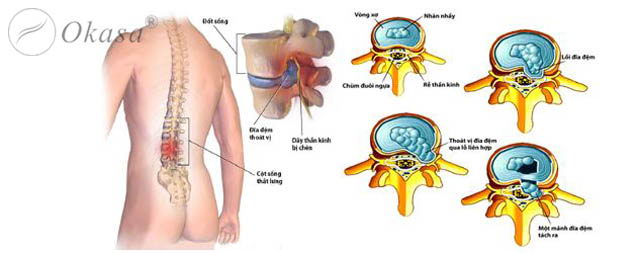 Phương pháp điều trị thoát vị đĩa đệm lưng