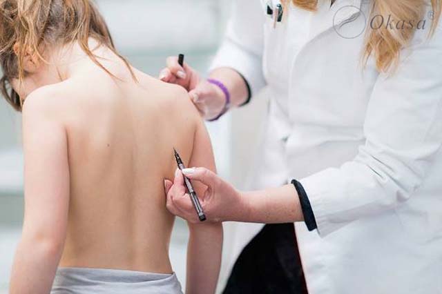 Phương pháp điều trị vẹo cột sống ngực