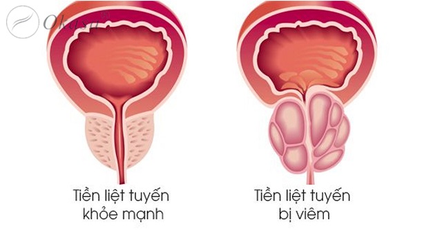 Phương pháp massage giúp kích thích tuyến tiền liệt