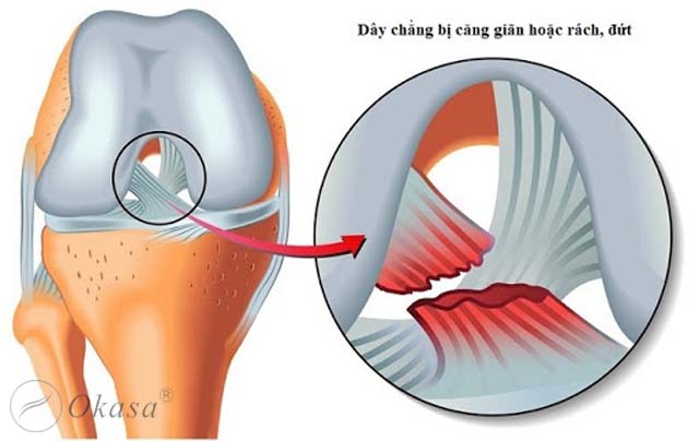 Phương pháp phục hồi chức năng giãn dây chằng đầu gối