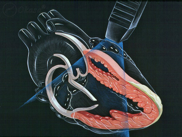 Phương pháp phục hồi chức năng tim mạch