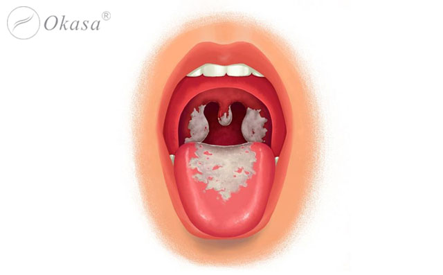 Một số bệnh viêm cơ tim thường gặp