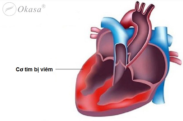 Một số bệnh viêm cơ tim thường gặp
