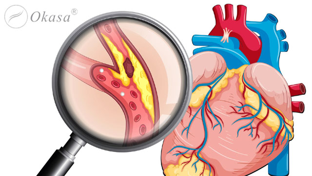 Nhồi máu cơ tim có thể gây biến chứng