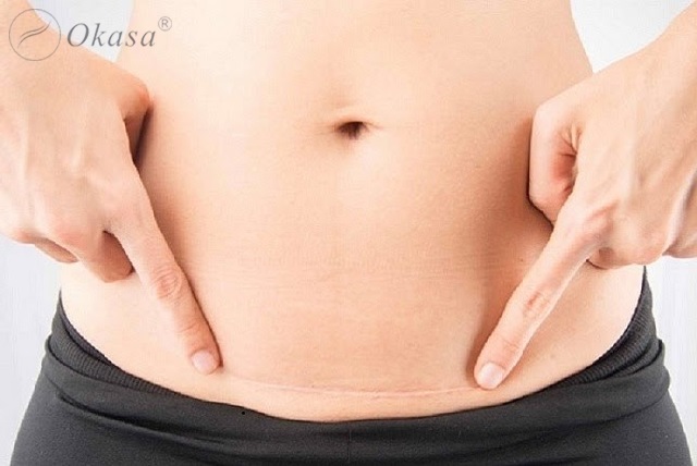 Sử dụng tinh dầu tràm trà trị sẹo lồi tại nhà