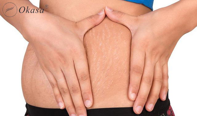 3 hỗn hợp massage trị rạn da cho chị em phụ nữ