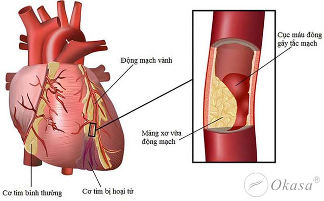 Chẩn đoán xơ vữa động mạch vành