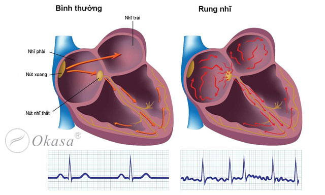 Chức năng và các bệnh lý của tâm nhĩ