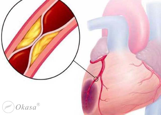 Cơ chế hình thành hội chứng mạch vành cấp
