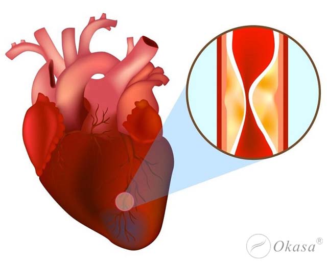 Cơ chế hình thành hội chứng mạch vành cấp