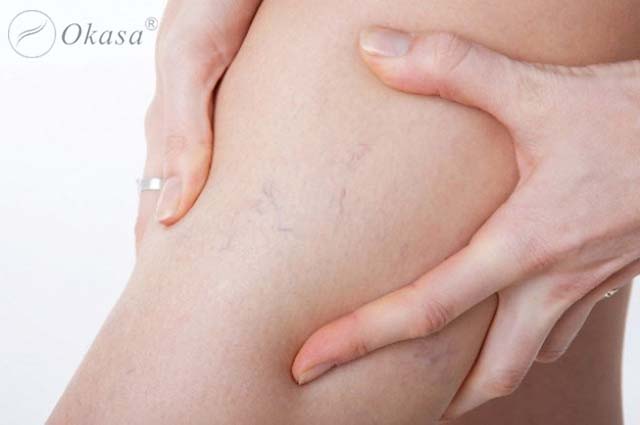 Dấu hiệu bệnh lý tĩnh mạch ngoại biên