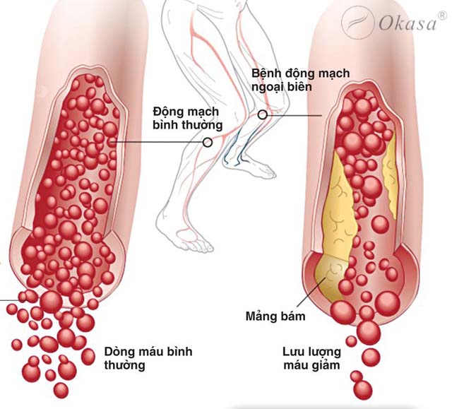 Dấu hiệu nhận biết bệnh động mạch ngoại biên