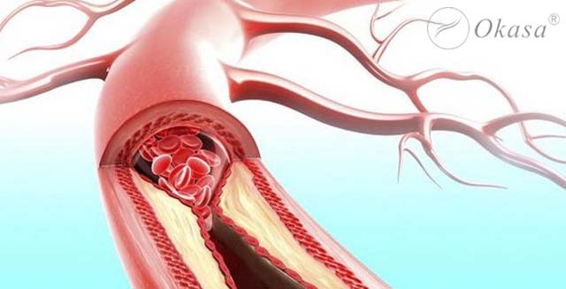 Dấu hiệu nhận biết bệnh động mạch ngoại biên