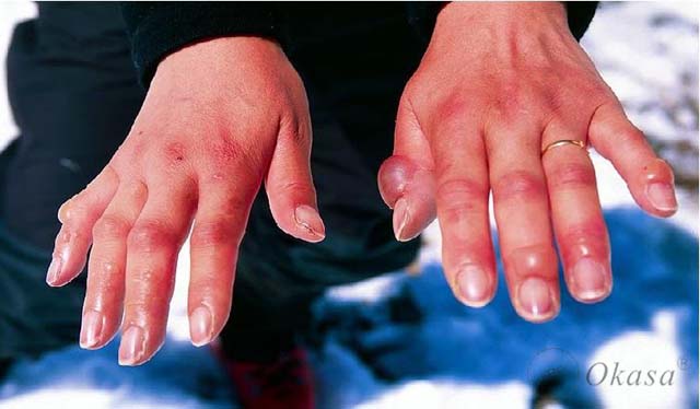 Dấu hiệu nhận biết bệnh động mạch ngoại biên