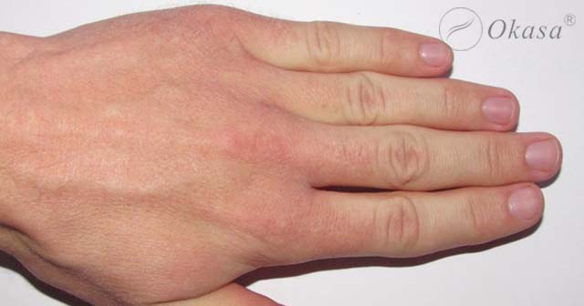 Dấu hiệu nhận biết bệnh động mạch ngoại biên