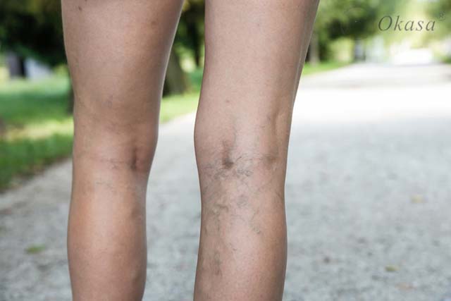 Điều trị huyết khối tĩnh mạch sâu ở chân