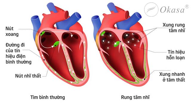 Hay hồi hộp có phải là dấu hiệu bệnh tim?