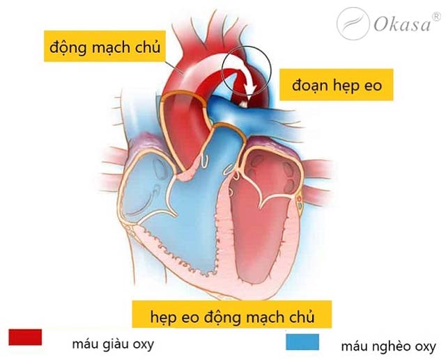 Hẹp eo động mạch chủ khiến huyết áp tăng