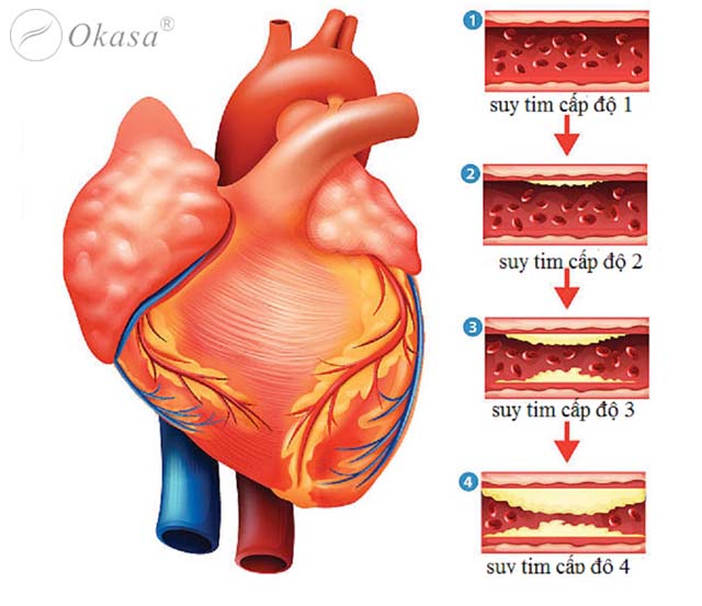 Hiểu về bệnh suy tim cấp