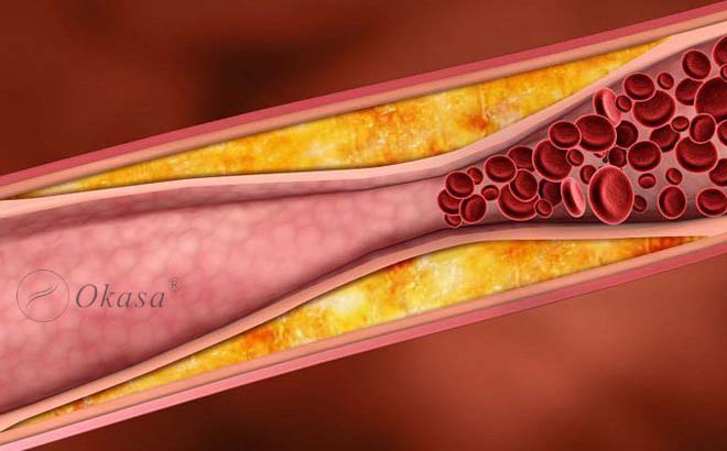Hiểu về bệnh xơ vữa động mạch vành?