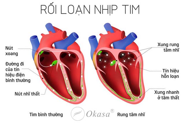 Hiểu về tình trạng rối loạn nhịp tim