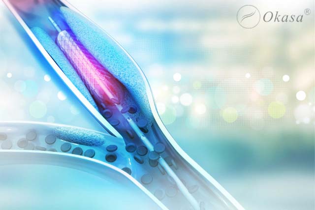 Kỹ thuật nong mạch vành