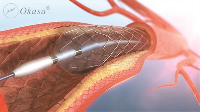 Kỹ thuật nong mạch vành
