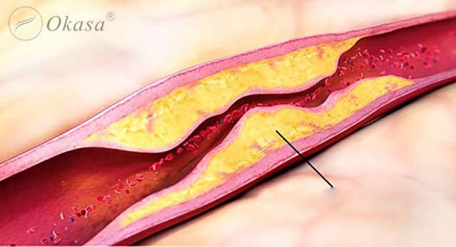 Kỹ thuật nong mạch vành