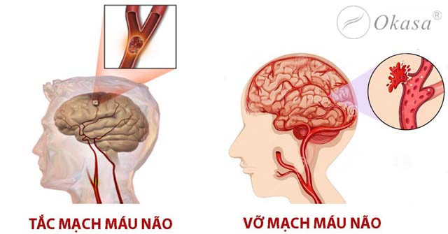 Phòng ngừa tai biến mạch máu não tái phát