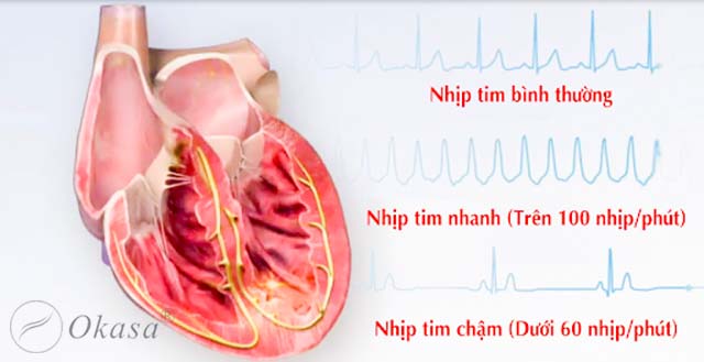 Phòng ngừa tình trạng suy tim cấp