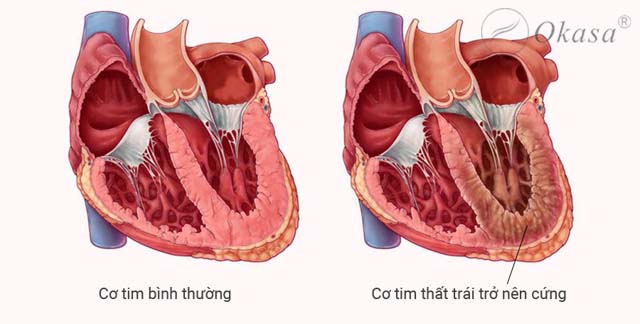 Phương pháp điều trị bệnh cơ tim hạn chế