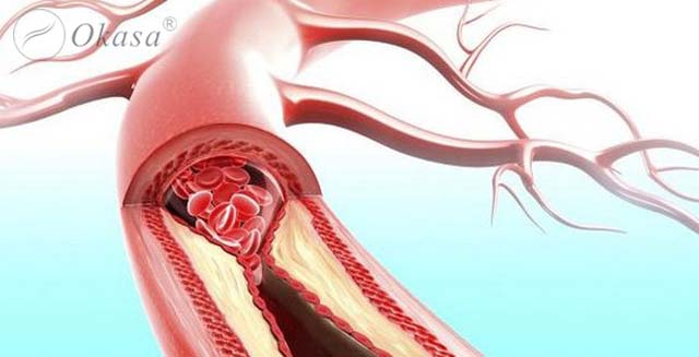 Tắc động mạch ngoại biên chi dưới là gì?