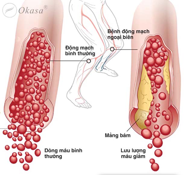 Tắc động mạch ngoại biên chi dưới là gì?