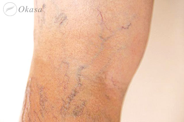 Tìm hiểu về cơ chế hình thành huyết khối