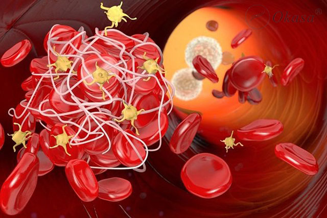 Tìm hiểu về cơ chế hình thành huyết khối