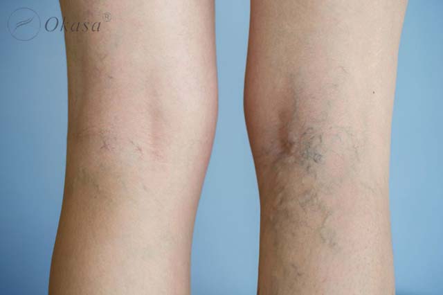 Tình trạng huyết khối tĩnh mạch sâu ở chân