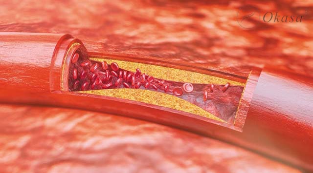 Xơ vữa động mạch vành và những biến chứng nguy hiểm