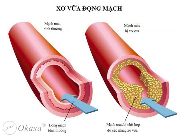 Xơ vữa động mạch vành và những biến chứng nguy hiểm