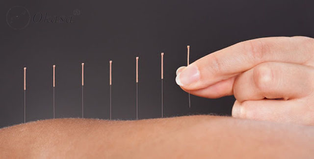 Tác dụng của châm cứu bấm huyệt