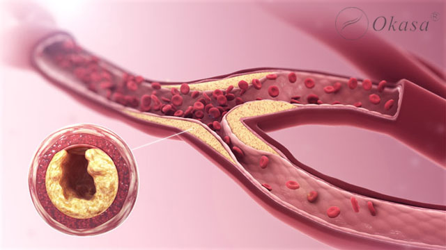 Tác dụng của massage cho bệnh nhân đột quỵ