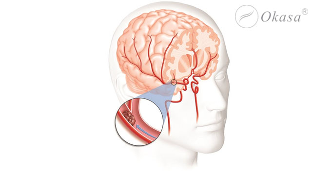 Tăng huyết áp có thể gây ra nhiều biến chứng nguy hiểm