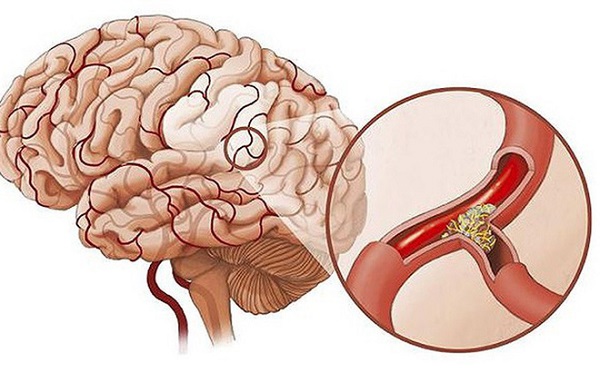 Thiếu máu não có thể gây đau đầu chóng mặt buồn nôn mệt mỏi