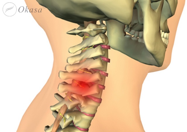 Thoát vị đĩa đệm cột sống cổ là gì ?