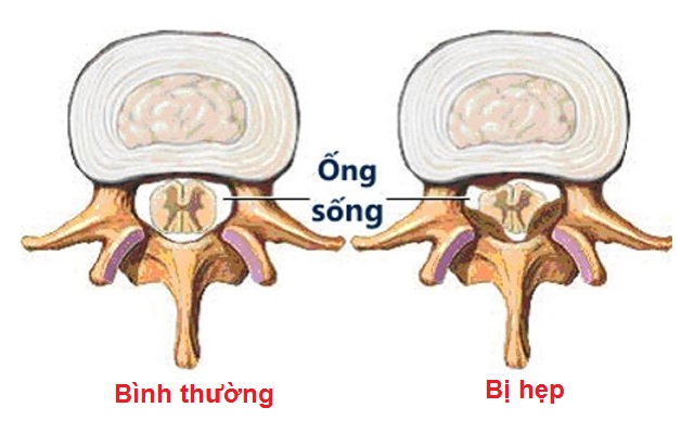 Thoát vị đĩa đệm cột sống cổ là gì ?