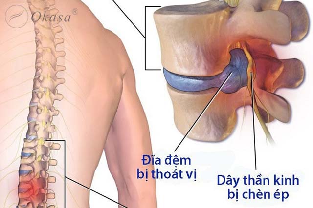 Thoát vị đĩa đệm cột sống thắt lưng và phương pháp chẩn đoán