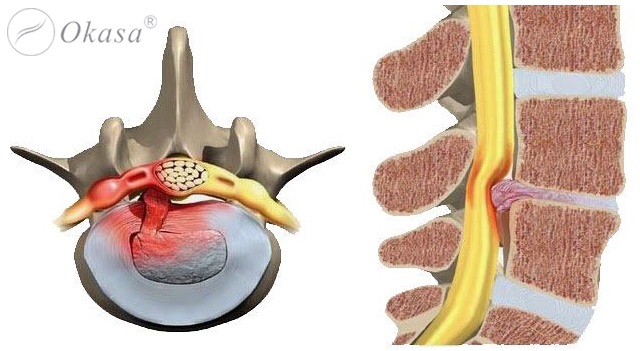 Thoát vị đĩa đệm di trú là gì