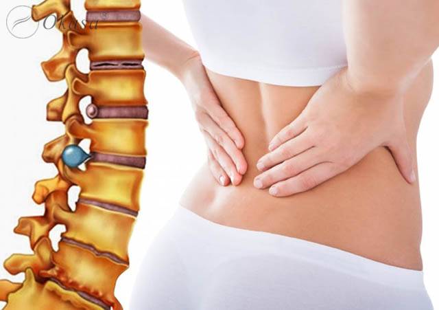 Thoát vị đĩa đệm lưng gây chèn ép rễ thần kinh