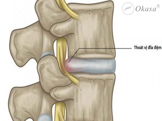 Thoát vị đĩa đệm lưng gây chèn ép rễ thần kinh