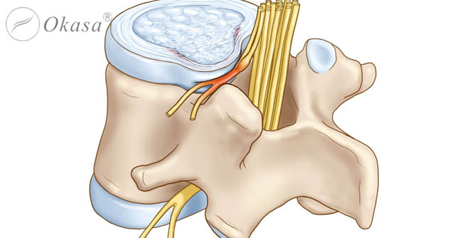 Thoát vị đĩa đệm lưng gây chèn ép rễ thần kinh